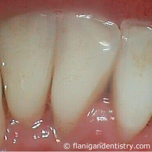 Flanigan Dentistry | Dental Prophylaxis after