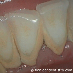 Flanigan Dentistry | Dental Prophylaxis before