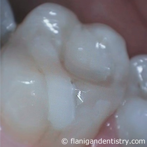 Flanigan Dentistry | Zirconia crown after