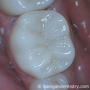 Flanigan Dentistry | Denver Dentist | Zirconia Crown After