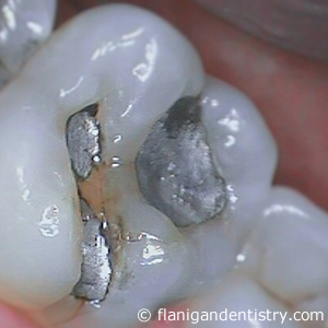 Flanigan Dentistry | Zirconia crown before