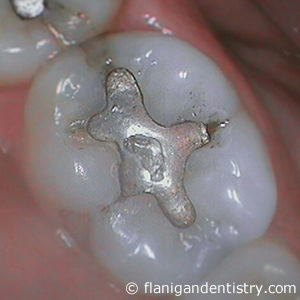 Flanigan Dentistry | Denver Dentist | Zirconia Crown Before-2