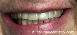 Flanigan Dentistry | Denver Dentist | Implants After