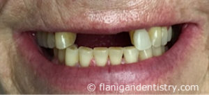 Flanigan Dentistry | Denver Dentist | Implants Before